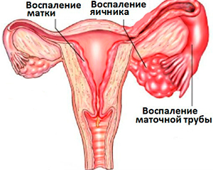 Воспаление яичников