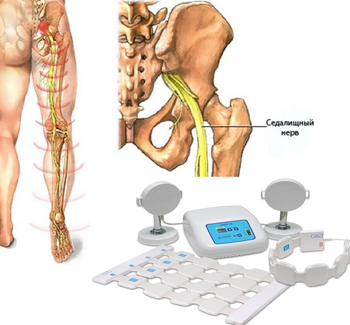 Магнитотерапия при воспалении седалищного или тройничного нерва