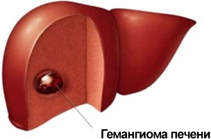 Магнитотерапия при гемангиоме