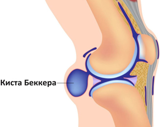 Магнитотерапия при кисте Бейкера (Беккера)