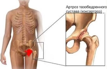 Магнитотерапия при коксартрозе