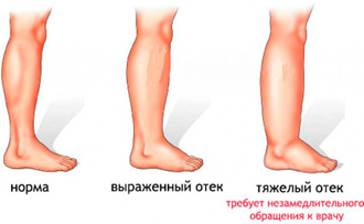 Магнитотерапия при отеках